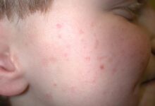 Keratosis pilaris cause treatment