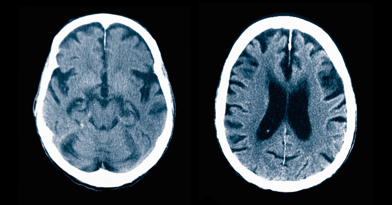 Mild cognitive impairment diagnosis