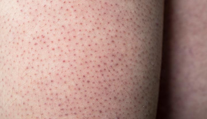 Keratosis pilaris cause treatment