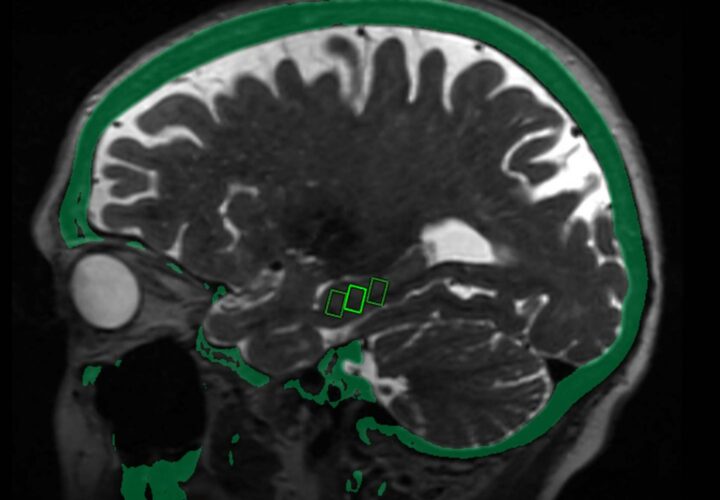 Blood brain barrier alzheimers ultrsound