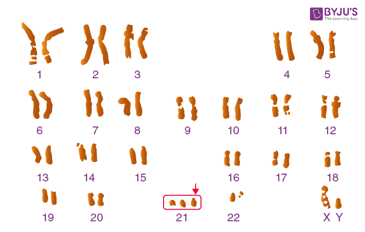 Down syndrome dna bones