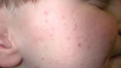 Keratosis pilaris cause treatment