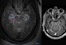 Blood brain barrier alzheimers ultrsound