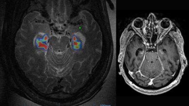 Blood brain barrier alzheimers ultrsound