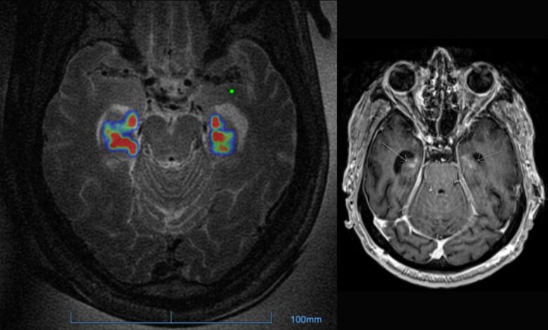 Blood brain barrier alzheimers ultrsound