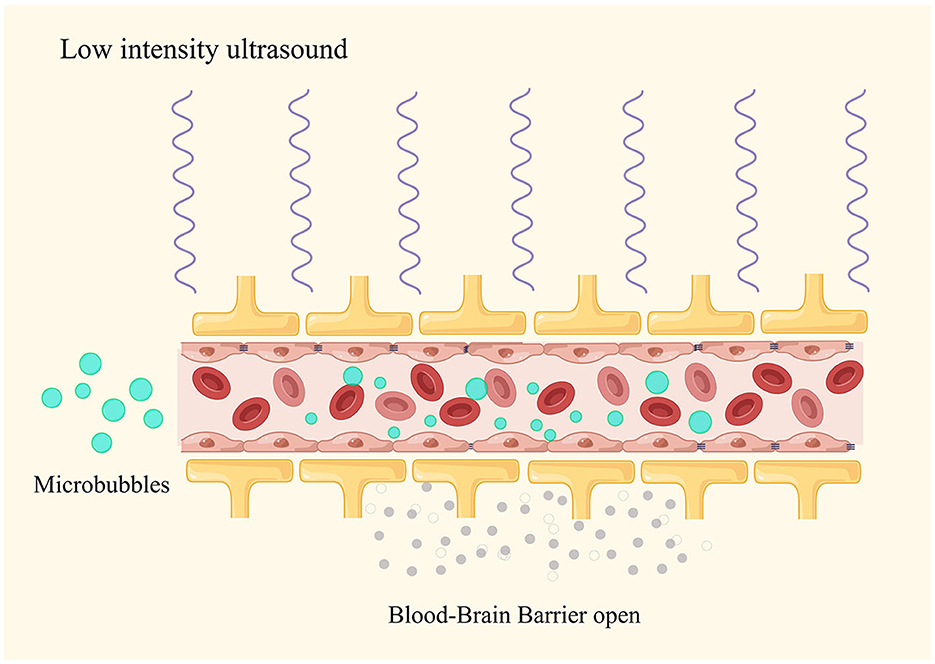 Blood brain barrier alzheimers ultrsound