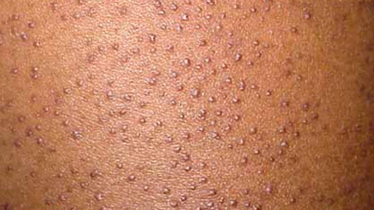 Keratosis pilaris cause treatment