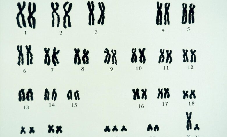 Down syndrome dna bones