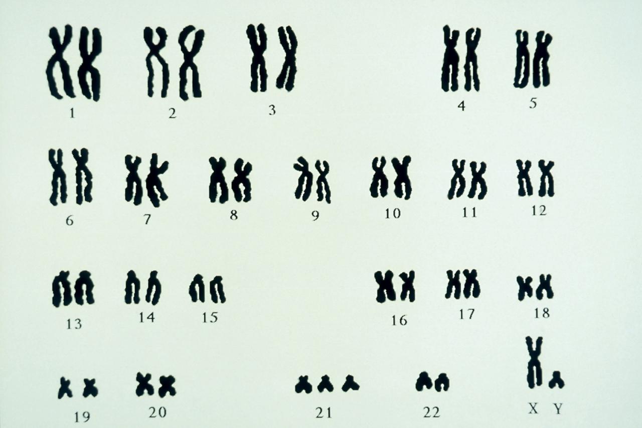 Down syndrome dna bones